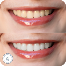 Load image into Gallery viewer, Teeth Whitening Kit
