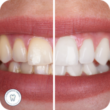 Load image into Gallery viewer, Teeth Whitening Kit
